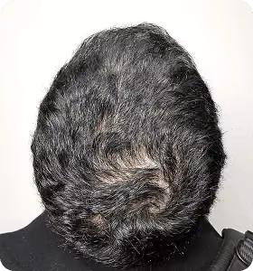 Vorher: Mann, 37 Jahre, Hinterkopf vor der regenerativen Haartherapie