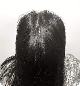 Nachher: Frau, 36 Jahre, Scheitel nach der regenerativen Haartherapie