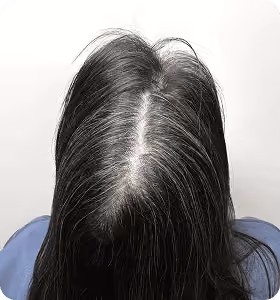 Vorher: Frau, 36 Jahre, Scheitel vor der regenerativen Haartherapie