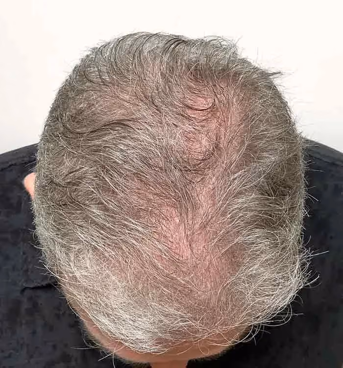 Nachher: Mann, 58 Jahre, Hinterkopf nach der regenerativen Haartherapie