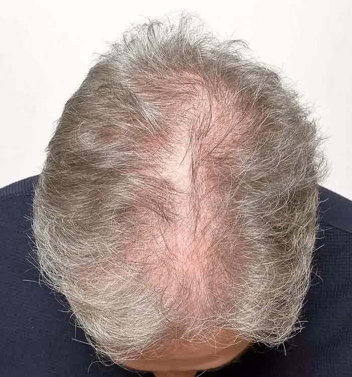 Vorher: Mann, 58 Jahre, Hinterkopf vor der regenerativen Haartherapie