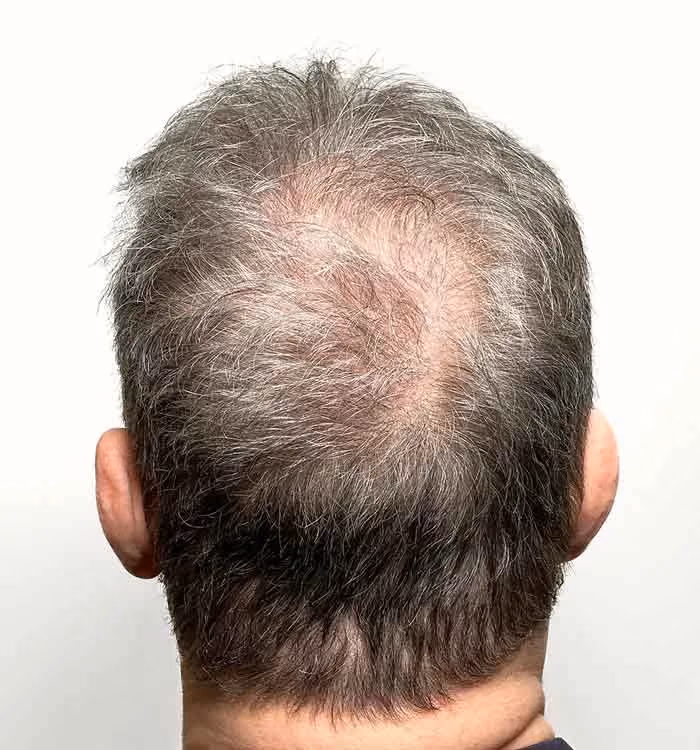 Vorher: Mann, 58 Jahre, Hinterkopf vor der regenerativen Haartherapie
