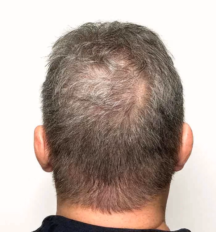 Nachher: Mann, 58 Jahre, Hinterkopf nach der regenerativen Haartherapie