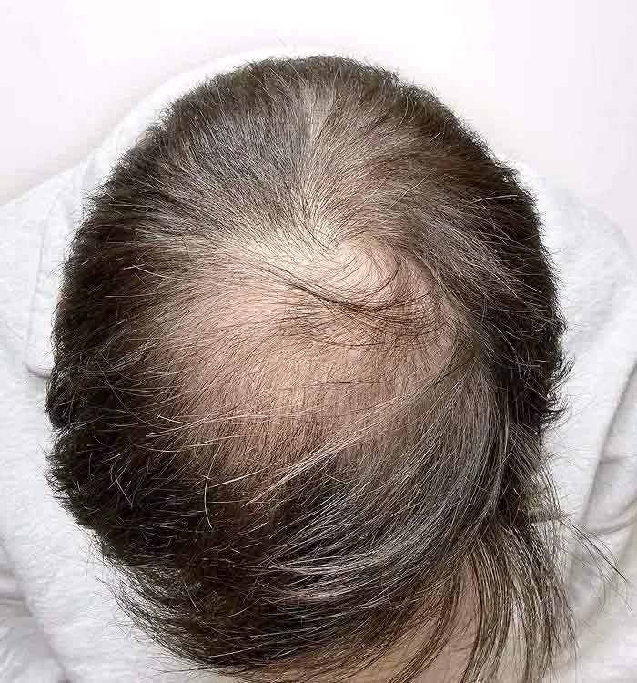 Vorher: Mann, 32 Jahre, Hinterkopf vor der regenerativen Haartherapie