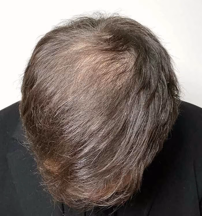 Nachher: Mann, 32 Jahre, Hinterkopf nach der regenerativen Haartherapie