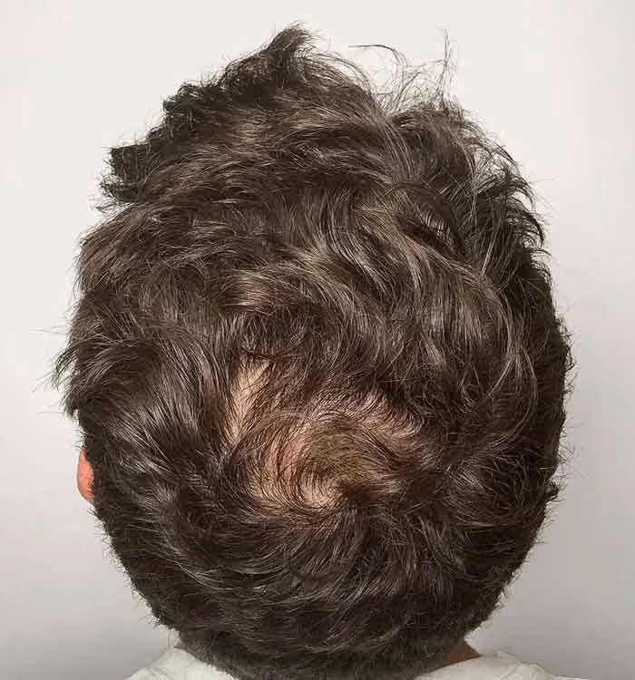 Nachher: Mann, 33 Jahre, Hinterkopf nach der regenerativen Haartherapie