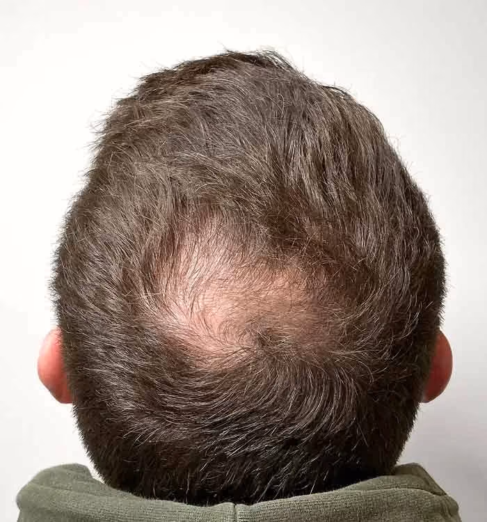Vorher: Mann, 33 Jahre, Hinterkopf vor der regenerativen Haartherapie