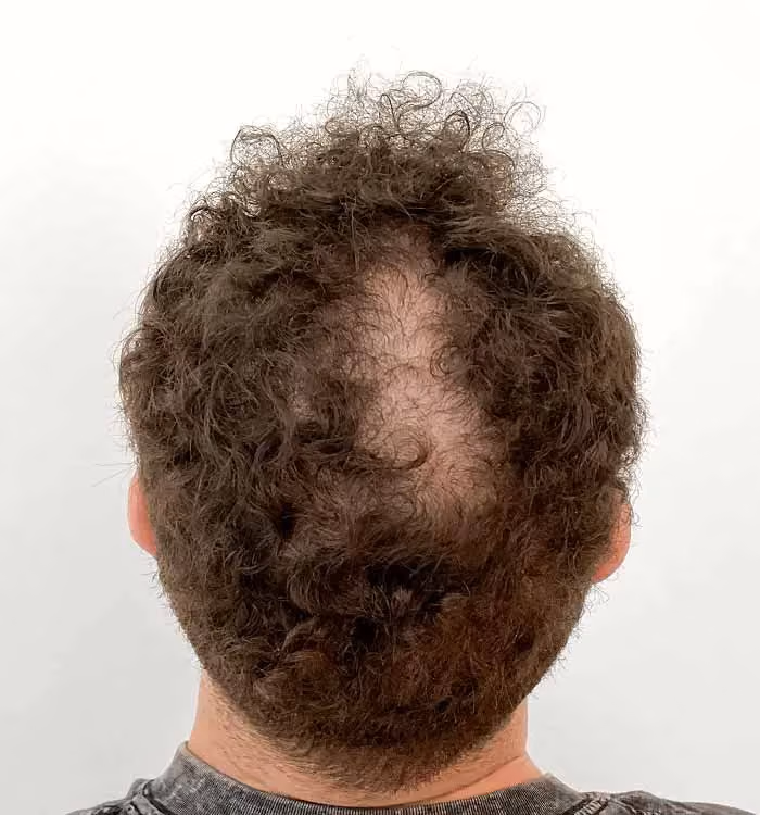 Vorher: Mann, 31 Jahre, Hinterkopf vor der regenerativen Haartherapie