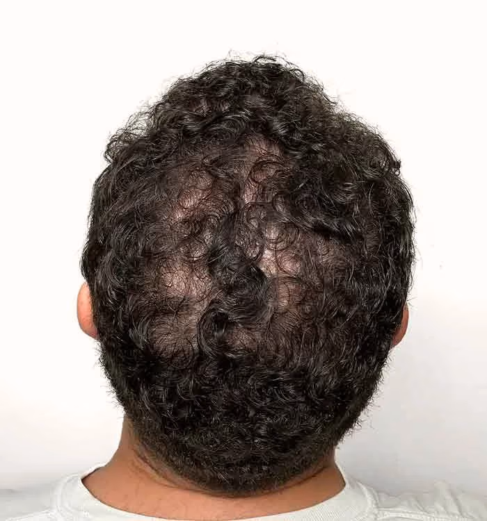 Nachher: Mann, 31 Jahre, Hinterkopf nach der regenerativen Haartherapie