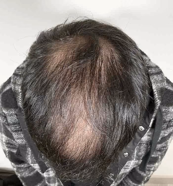 Vorher: Mann, 37 Jahre, Hinterkopf vor der regenerativen Haartherapie