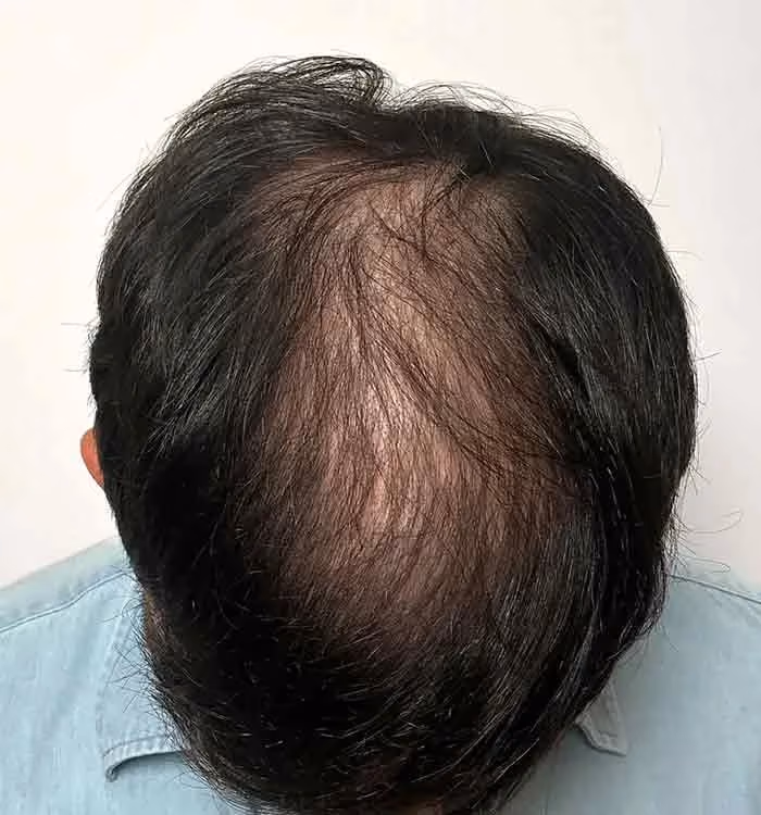 Nachher: Mann, 37 Jahre, Hinterkopf nach der regenerativen Haartherapie