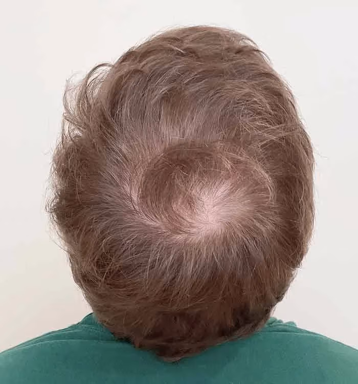 Vorher: Mann, 29 Jahre, Hinterkopf vor der regenerativen Haartherapie