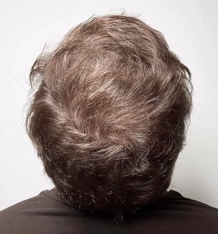 Nachher: Mann, 29 Jahre, Hinterkopf nach der regenerativen Haartherapie