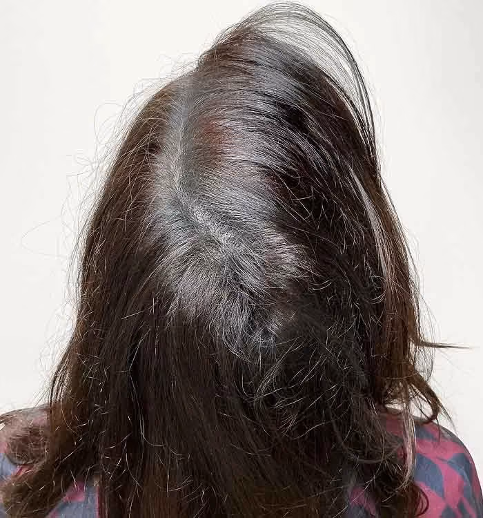 Nachher: Frau, 48 Jahre, Scheitel nach der regenerativen Haartherapie
