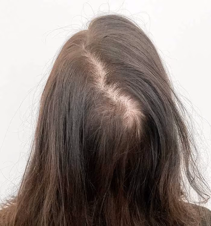 Vorher: Frau, 48 Jahre, Scheitel vor der regenerativen Haartherapie