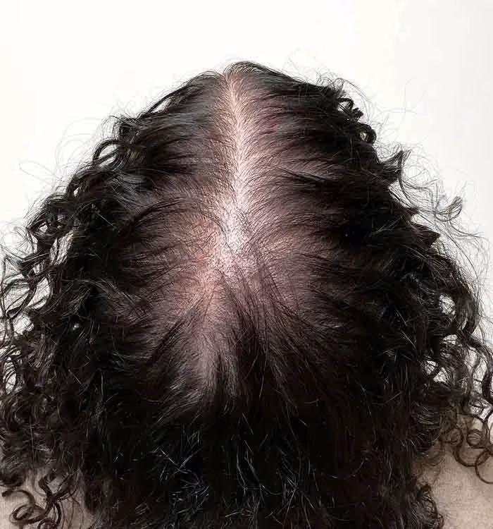 Nachher: Frau, 36 Jahre, Scheitel nach der regenerativen Haartherapie
