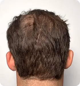 Nachher: Mann, 32 Jahre, Hinterkopf nach der regenerativen Haartherapie