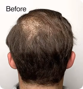 Vorher: Mann, 32 Jahre, Hinterkopf vor der regenerativen Haartherapie