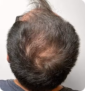 Nachher: Mann, 55 Jahre, Hinterkopf nach der regenerativen Haartherapie