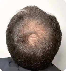 Vorher: Mann, 55 Jahre, Hinterkopf vor der regenerativen Haartherapie