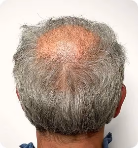 Vorher: Mann, 52 Jahre, Hinterkopf vor der regenerativen Haartherapie