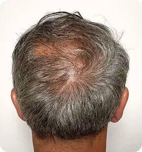 Nachher: Mann, 52 Jahre, Hinterkopf nach der regenerativen Haartherapie