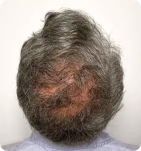 Nachher: Mann, 52 Jahre, Hinterkopf nach der regenerativen Haartherapie