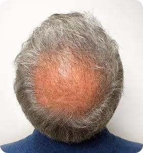 Vorher: Mann, 52 Jahre, Hinterkopf vor der regenerativen Haartherapie