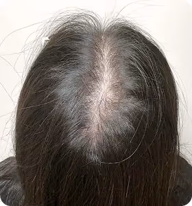 Vorher: Frau, 25 Jahre, Scheitel vor der regenerativen Haartherapie