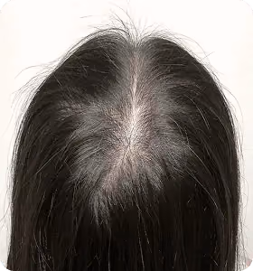 Nachher: Frau, 25 Jahre, Scheitel nach der regenerativen Haartherapie