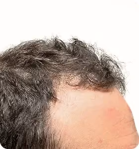 Vorher: Mann, 42 Jahre, Haarlinie vor der regenerativen Haartherapie