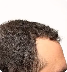 Nachher: Mann, 42 Jahre, Haarlinie nach der regenerativen Haartherapie