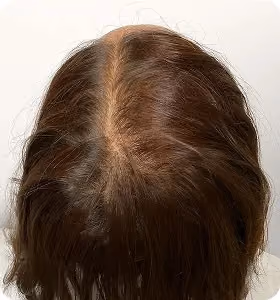 Nachher: Frau, 43 Jahre, Scheitel nach der regenerativen Haartherapie