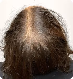 Vorher: Frau, 43 Jahre, Scheitel vor der regenerativen Haartherapie