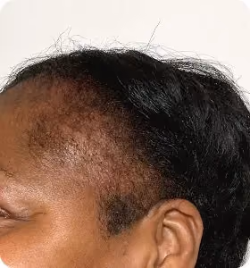 Vorher: Frau, 57 Jahre, Geheimratsecken vor der regenerativen Haartherapie