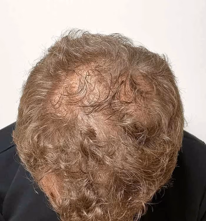 Vorher: Mann, 44 Jahre, Hinterkopf vor der regenerativen Haartherapie