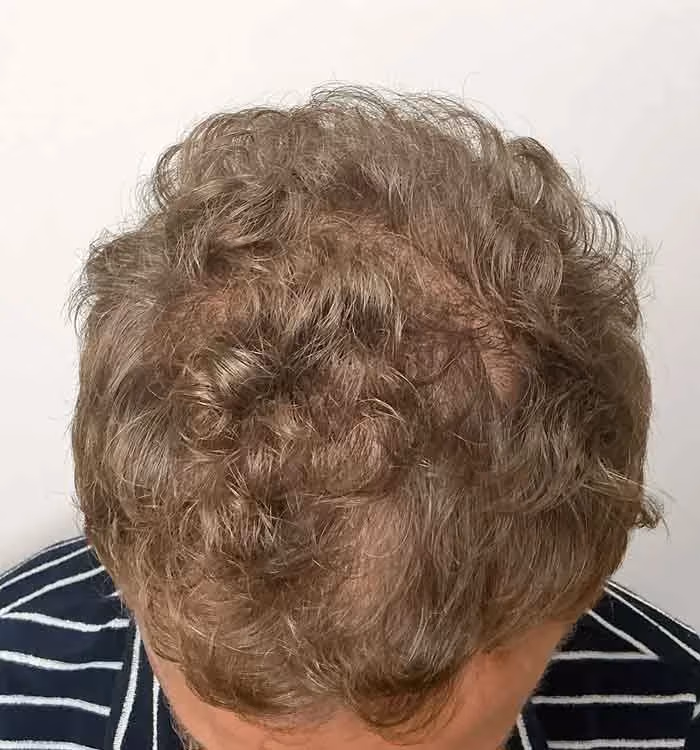 Nachher: Mann, 44 Jahre, Hinterkopf nach der regenerativen Haartherapie