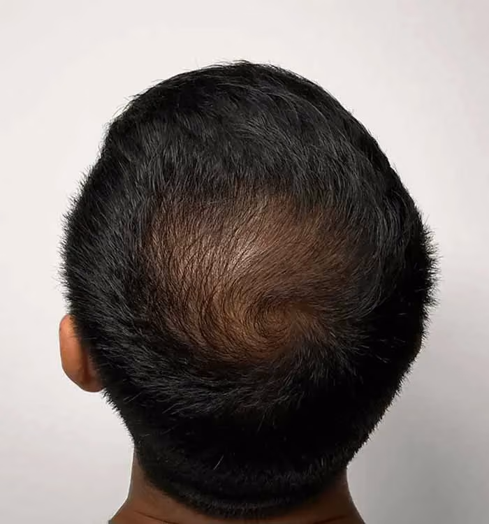 Nachher: Mann, 30 Jahre, Hinterkopf nach der regenerativen Haartherapie