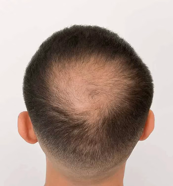 Vorher: Mann, 30 Jahre, Hinterkopf vor der regenerativen Haartherapie