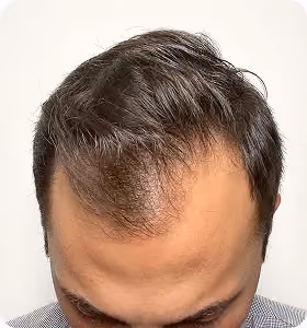 Vorher: Mann, 33 Jahre, Haarlinie vor der regenerativen Haartherapie