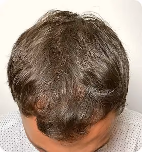 Nachher: Mann, 33 Jahre, Haarlinie nach der regenerativen Haartherapie