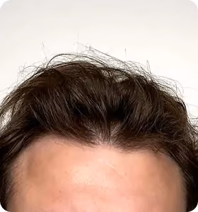 Nachher: Mann, 28 Jahre, Haarlinie nach der regenerativen Haartherapie