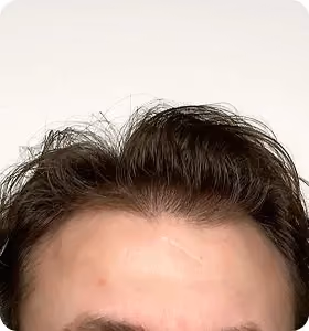 Vorher: Mann, 28 Jahre, Haarlinie vor der regenerativen Haartherapie