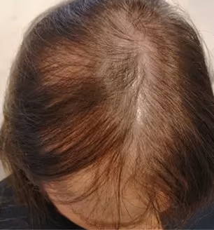 Vorher: Frau, 46 Jahre, Hinterkopf vor der regenerativen Haartherapie