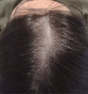 Vorher: Frau, 32 Jahre, Scheitel vor der regenerativen Haartherapie
