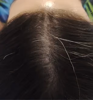 Nachher: Frau, 32 Jahre, Scheitel nach der regenerativen Haartherapie