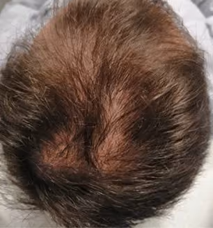 Vorher: Mann, 41 Jahre, Hinterkopf vor der regenerativen Haartherapie