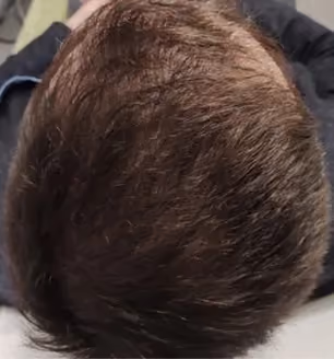 Nachher: Mann, 41 Jahre, Hinterkopf nach der regenerativen Haartherapie