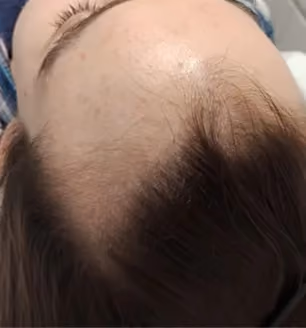 Vorher: Frau, 29 Jahre, Geheimratsecken vor der regenerativen Haartherapie