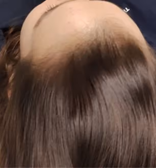 Nachher: Frau, 29 Jahre, Geheimratsecken nach der regenerativen Haartherapie